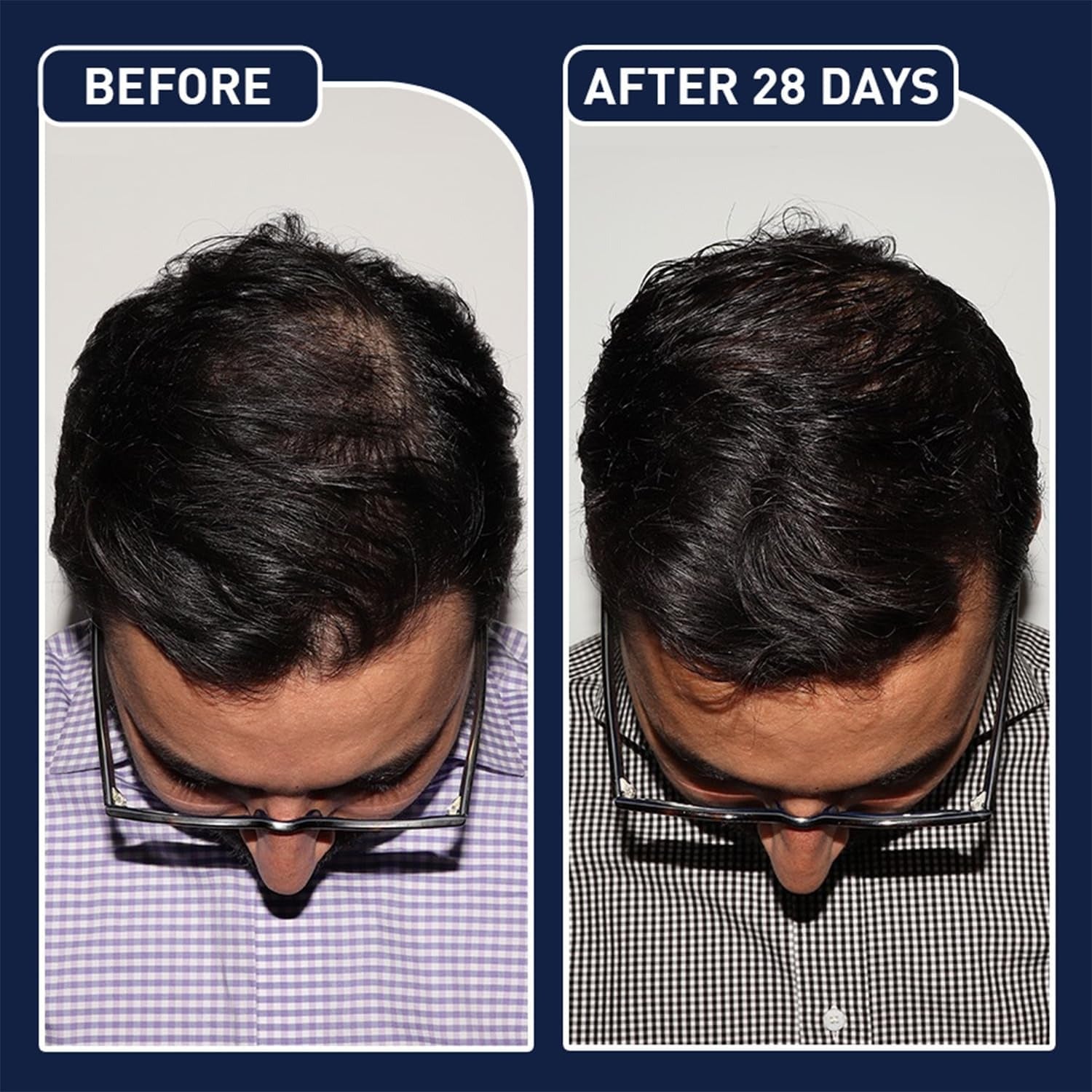 FEGPlus Minoxidil Beard & Hair Growth Serum – 2-5% Strength, 30ml