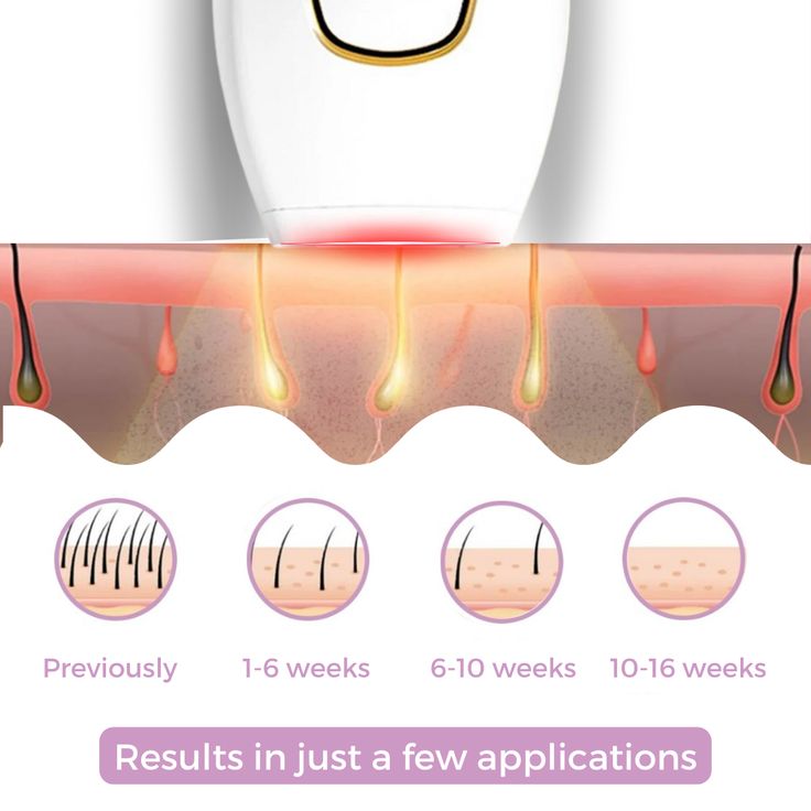 IPL Hair Removal System – Permanent Laser Epilator